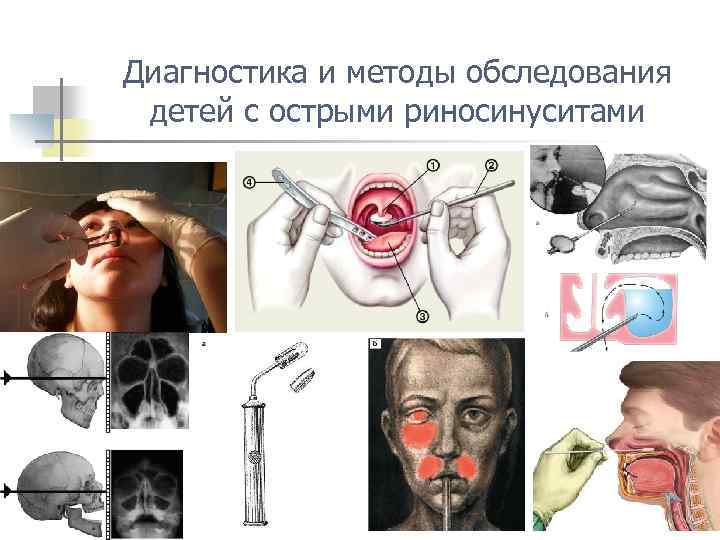 Диагностика и методы обследования детей с острыми риносинуситами 
