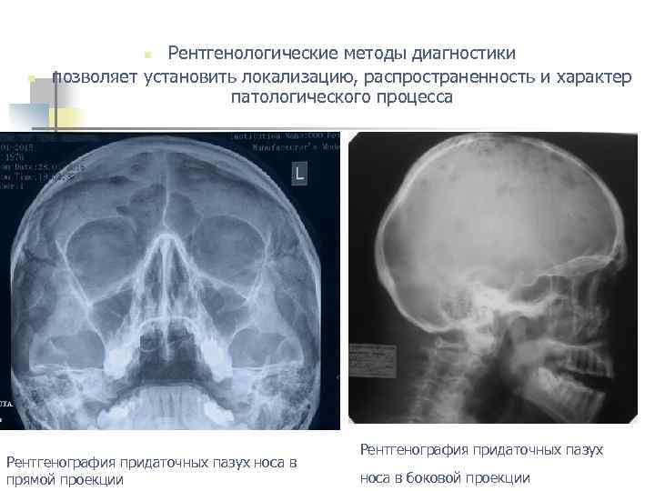 Рентгенологические методы диагностики позволяет установить локализацию, распространенность и характер патологического процесса n n Рентгенография