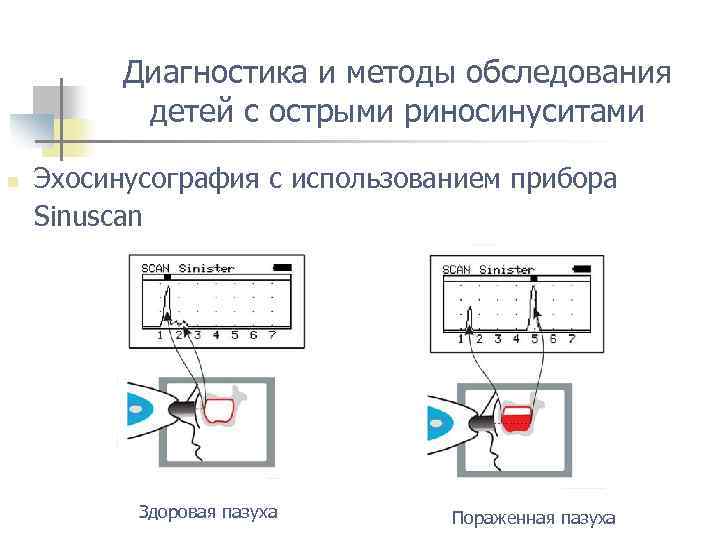 Диагностика и методы обследования детей с острыми риносинуситами n Эхосинусография с использованием прибора Sinuscan