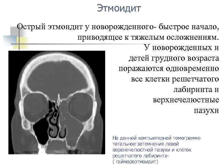 Этмоидит Острый этмоидит у новорожденного- быстрое начало, приводящее к тяжелым осложнениям. У новорожденных и