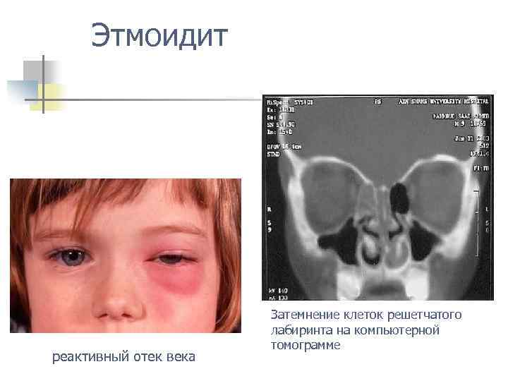 Этмоидит реактивный отек века Затемнение клеток решетчатого лабиринта на компьютерной томограмме 