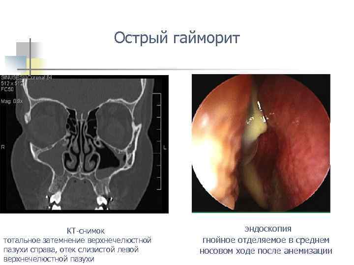 Острый гайморит КТ-снимок тотальное затемнение верхнечелюстной пазухи справа, отек слизистой левой верхнечелюстной пазухи эндоскопия