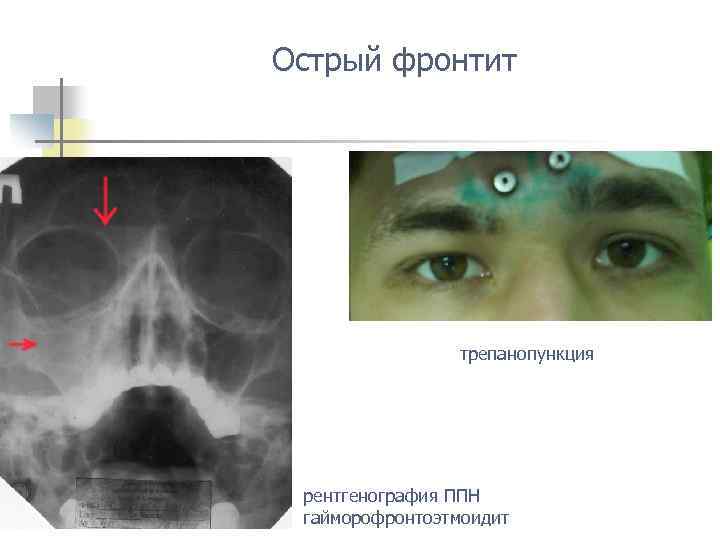 Острый фронтит трепанопункция рентгенография ППН гайморофронтоэтмоидит 