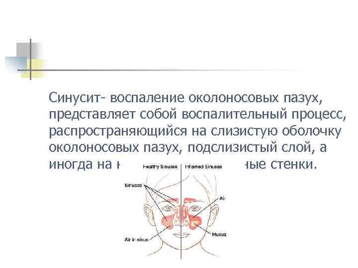 Синусит- воспаление околоносовых пазух, представляет собой воспалительный процесс, распространяющийся на слизистую оболочку околоносовых пазух,