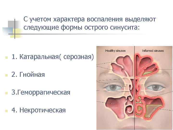 С учетом характера воспаления выделяют следующие формы острого синусита: n 1. Катаральная( серозная) n