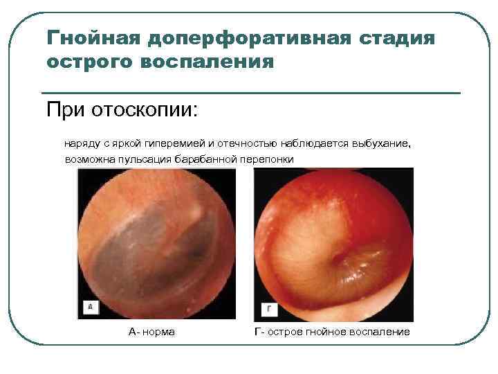 Гнойная доперфоративная стадия острого воспаления При отоскопии: наряду с яркой гиперемией и отечностью наблюдается