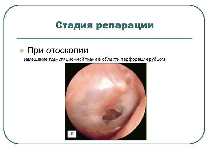 Стадия репарации l При отоскопии замещение грануляционной ткани в области перфорации рубцом 