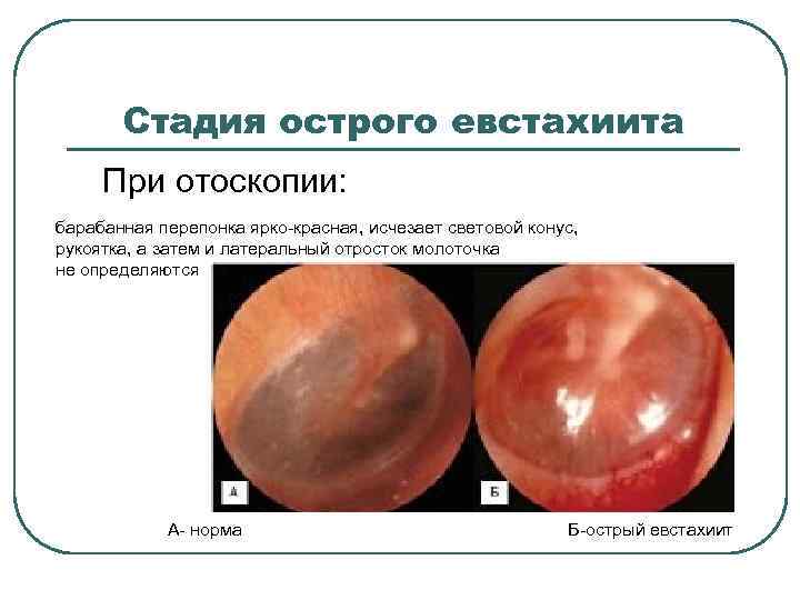 Стадия острого евстахиита При отоскопии: барабанная перепонка ярко-красная, исчезает световой конус, рукоятка, а затем