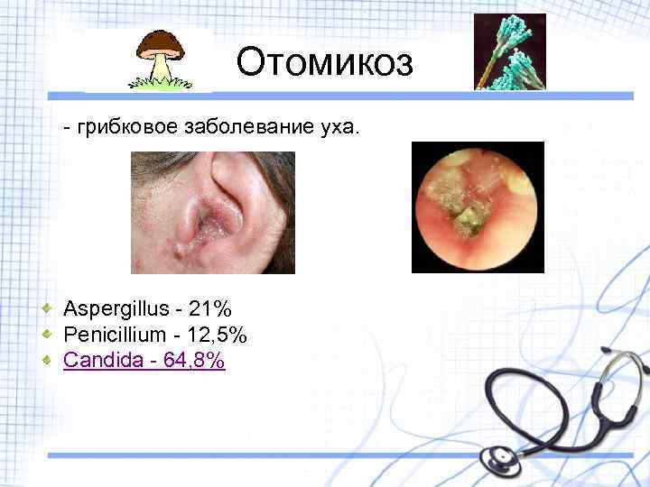 Отомикоз - грибковое заболевание уха. Aspergillus - 21% Penicillium - 12, 5% Candida -