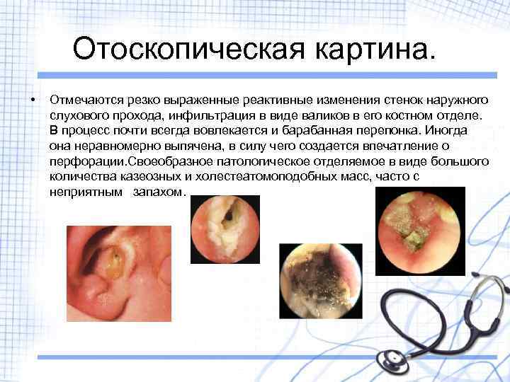Отоскопическая картина. • Отмечаются резко выраженные реактивные изменения стенок наружного слухового прохода, инфильтрация в