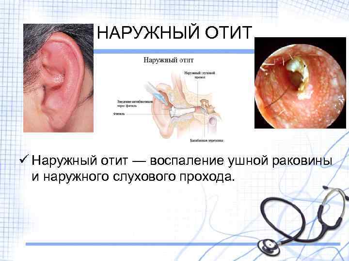 НАРУЖНЫЙ ОТИТ ü Наружный отит — воспаление ушной раковины и наружного слухового прохода. 