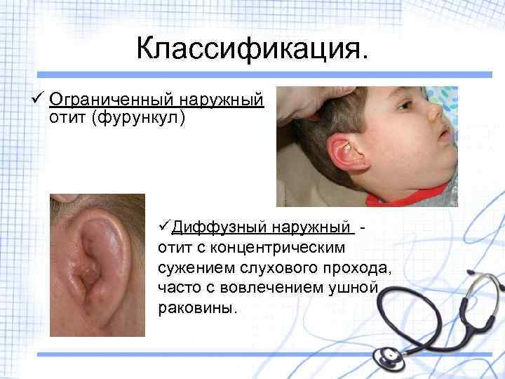 Классификация. ü Ограниченный наружный отит (фурункул) üДиффузный наружный отит с концентрическим сужением слухового прохода,