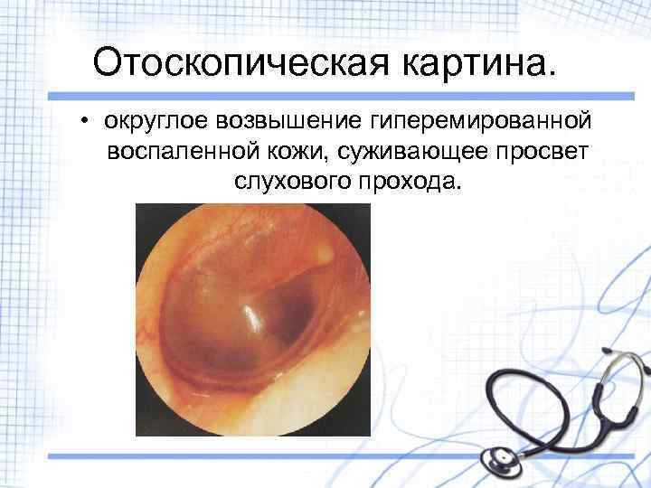 Отоскопическая картина. • округлое возвышение гиперемированной воспаленной кожи, суживающее просвет слухового прохода. 