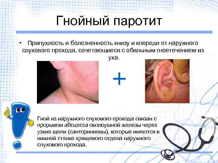 Гнойный паротит • Припухлость и болезненность книзу и кпереди от наружного слухового прохода, сочетающиеся