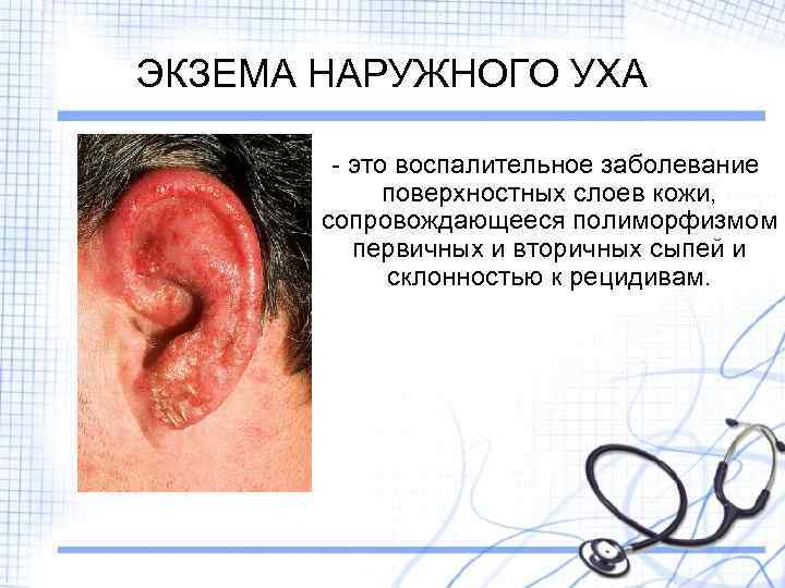 ЭКЗЕМА НАРУЖНОГО УХА - это воспалительное заболевание поверхностных слоев кожи, сопровождающееся полиморфизмом первичных и