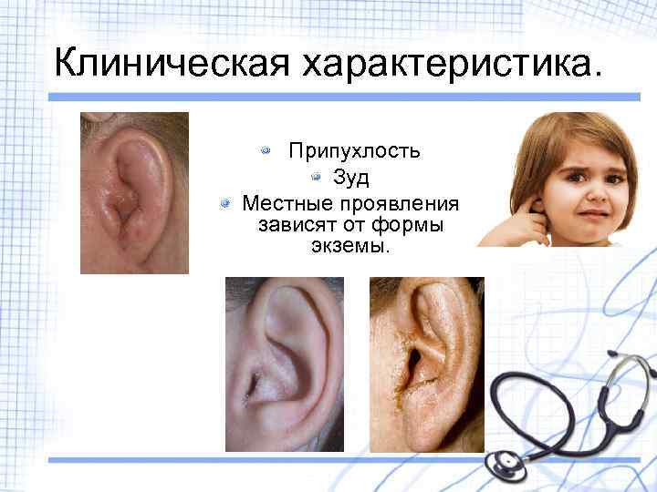 Клиническая характеристика. Припухлость Зуд Местные проявления зависят от формы экземы. 