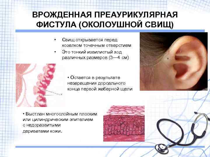 ВРОЖДЕННАЯ ПРЕАУРИКУЛЯРНАЯ ФИСТУЛА (ОКОЛОУШНОЙ СВИЩ) • • Свищ открывается перед козелком точечным отверстием Это