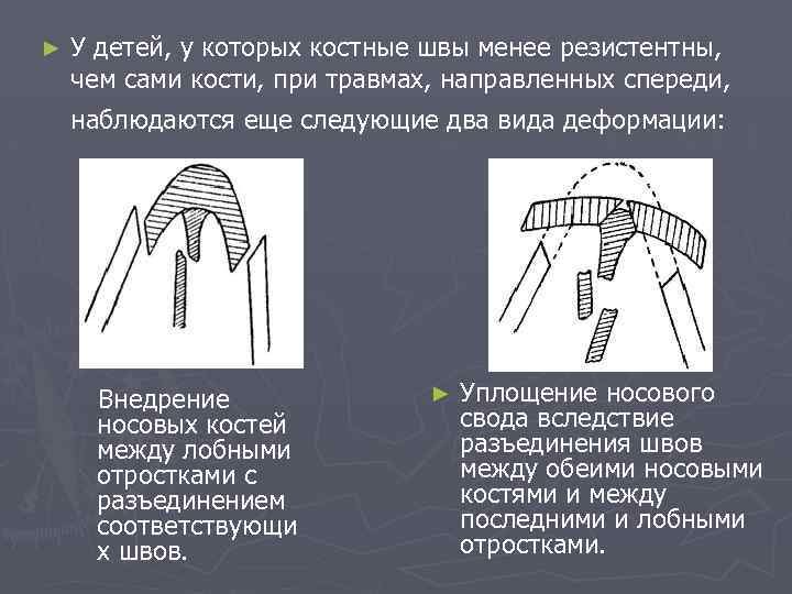 ► У детей, у которых костные швы менее резистентны, чем сами кости, при травмах,