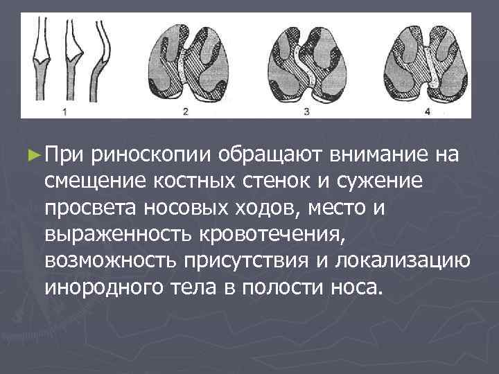 ► При риноскопии обращают внимание на смещение костных стенок и сужение просвета носовых ходов,