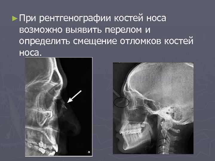 Закрытый перелом костей носа карта вызова