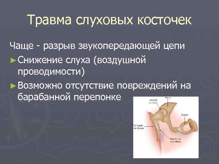Травма слуховых косточек Чаще - разрыв звукопередающей цепи ► Снижение слуха (воздушной проводимости) ►