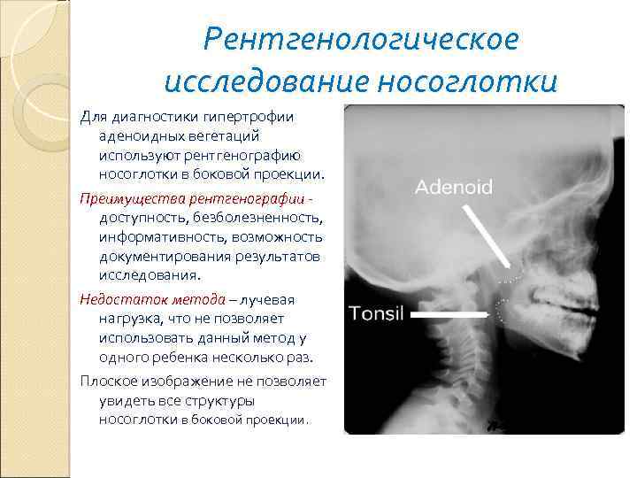 Аденоиды 3 степени фото рентген