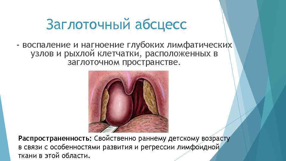 Заглоточный абсцесс - воспаление и нагноение глубоких лимфатических узлов и рыхлой клетчатки, расположенных в