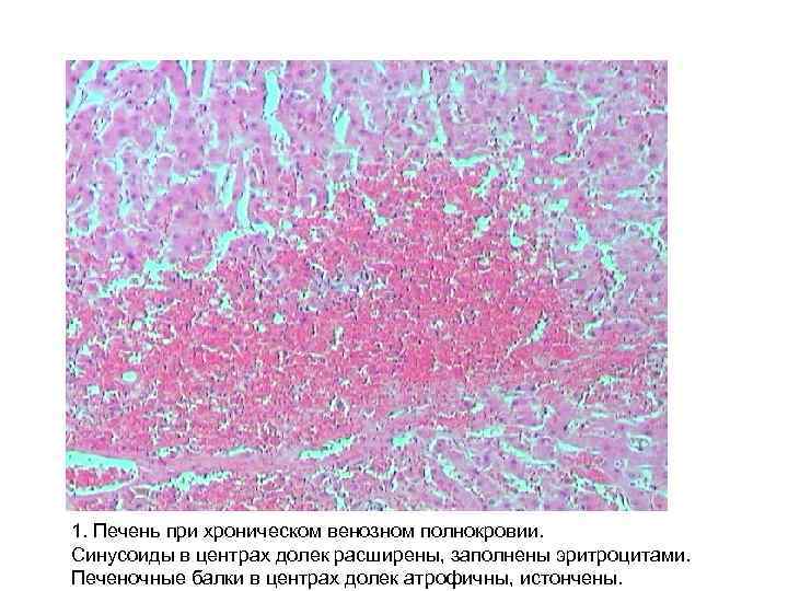1. Печень при хроническом венозном полнокровии. Синусоиды в центрах долек расширены, заполнены эритроцитами. Печеночные