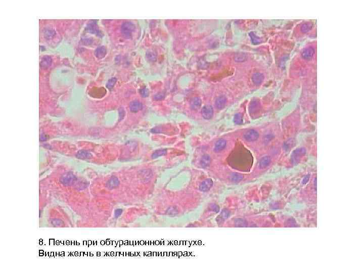 8. Печень при обтурационной желтухе. Видна желчь в желчных капиллярах. 