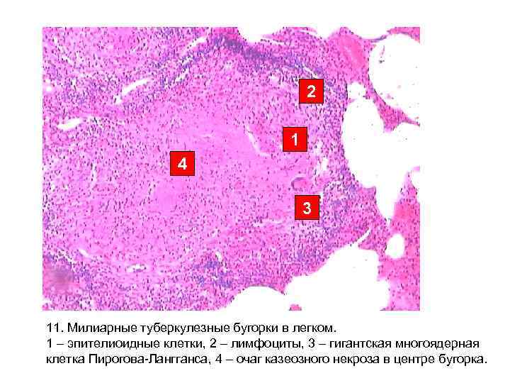 2 1 4 3 11. Милиарные туберкулезные бугорки в легком. 1 – эпителиоидные клетки,
