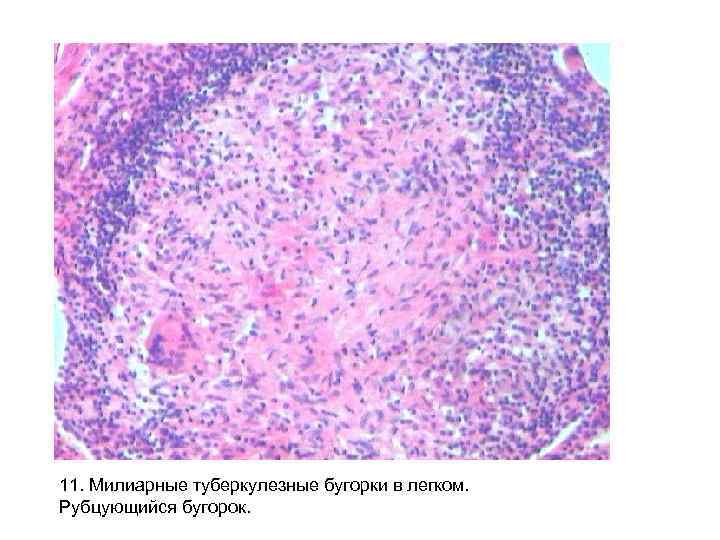 11. Милиарные туберкулезные бугорки в легком. Рубцующийся бугорок. 
