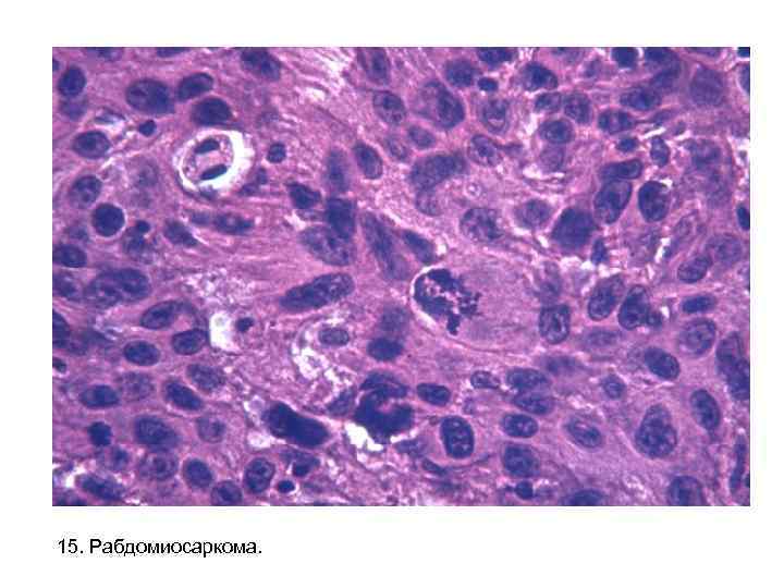 15. Рабдомиосаркома. 