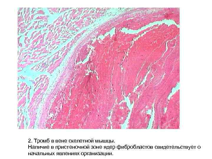 2. Тромб в вене скелетной мышцы. Наличие в пристеночной зоне ядер фибробластов свидетельствует о