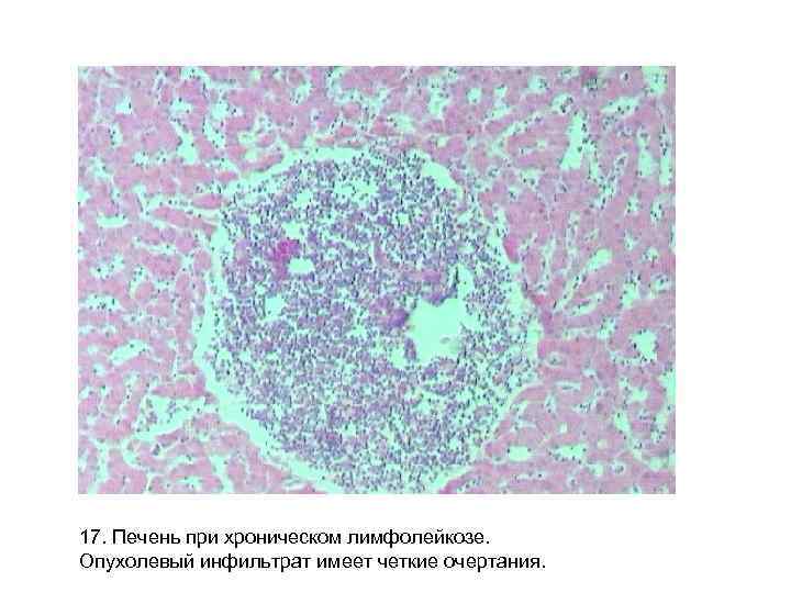17. Печень при хроническом лимфолейкозе. Опухолевый инфильтрат имеет четкие очертания. 