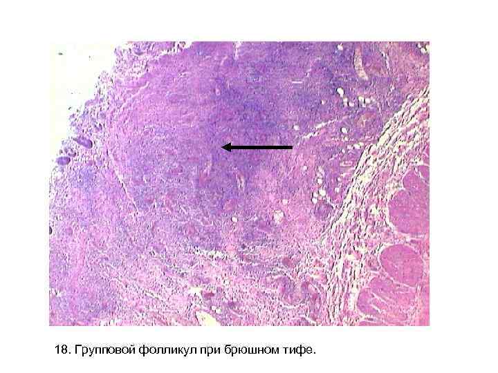18. Групповой фолликул при брюшном тифе. 