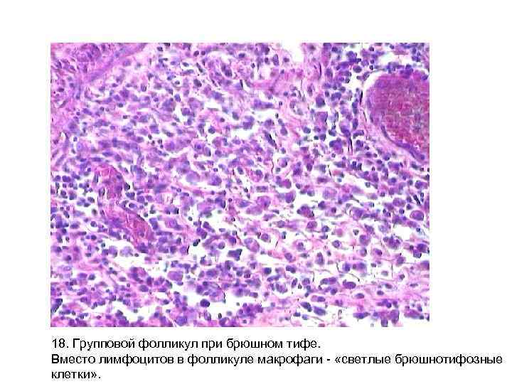 18. Групповой фолликул при брюшном тифе. Вместо лимфоцитов в фолликуле макрофаги - «светлые брюшнотифозные