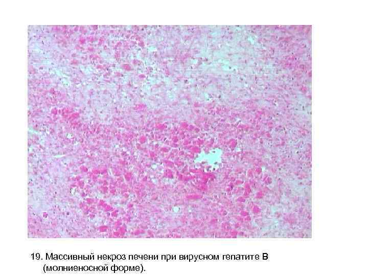 19. Массивный некроз печени при вирусном гепатите В (молниеносной форме). 