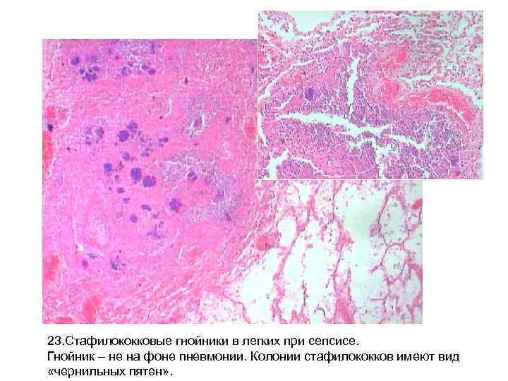 23. Стафилококковые гнойники в легких при сепсисе. Гнойник – не на фоне пневмонии. Колонии