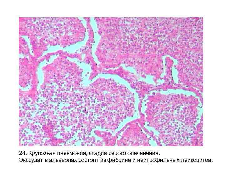 24. Крупозная пневмония, стадия серого опеченения. Экссудат в альвеолах состоит из фибрина и нейтрофильных