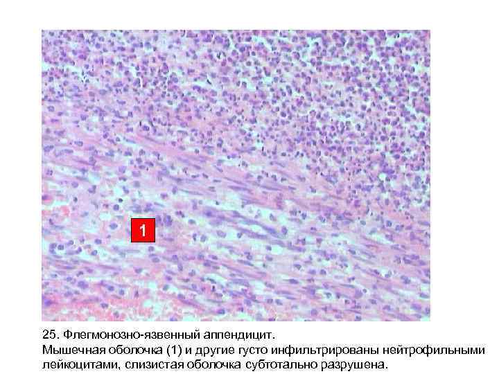 1 25. Флегмонозно-язвенный аппендицит. Мышечная оболочка (1) и другие густо инфильтрированы нейтрофильными лейкоцитами, слизистая