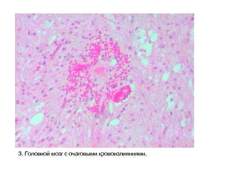 3. Головной мозг с очаговыми кровоизлияниями. 