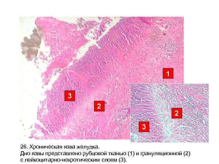 1 3 2 2 3 26. Хроническая язва желудка. Дно язвы представлено рубцовой тканью