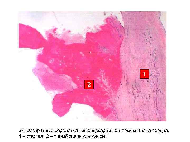 1 2 27. Возвратный бородавчатый эндокардит створки клапана сердца. 1 – створка, 2 –