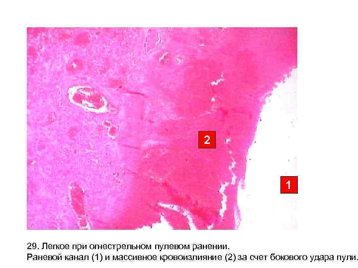 2 1 29. Легкое при огнестрельном пулевом ранении. Раневой канал (1) и массивное кровоизлияние