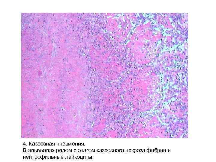 Стенка хронической туберкулезной каверны микропрепарат