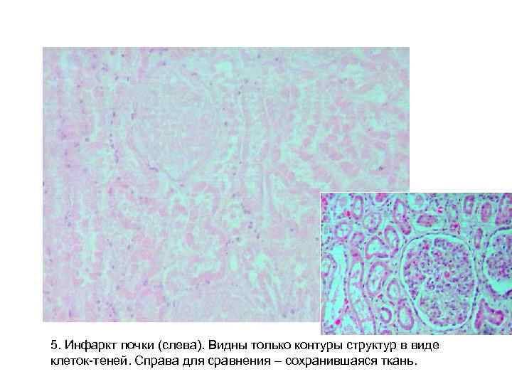 5. Инфаркт почки (слева). Видны только контуры структур в виде клеток-теней. Справа для сравнения