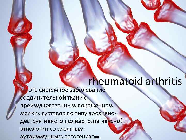 rheumatoid arthritis — это системное заболевание соединительной ткани с преимущественным поражением мелких суставов по