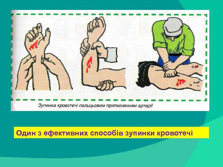 stack trace: Один з ефективних способів зупинки кровотечі 