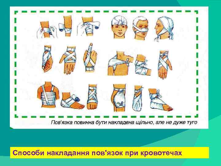 stack trace: Способи накладання пов'язок при кровотечах 