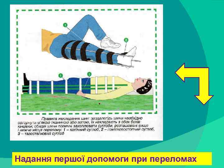 stack trace: Надання першої допомоги при переломах 